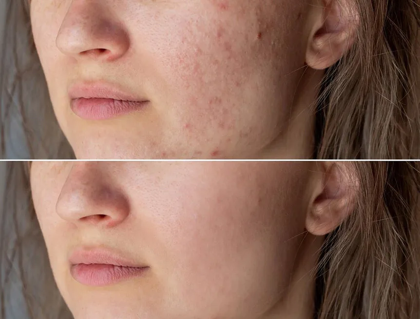 BIO Antiblemish s Levandulí Chodouňskou Roll-on, 10 ml